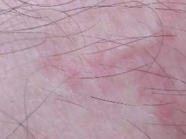 bed bug skin rash