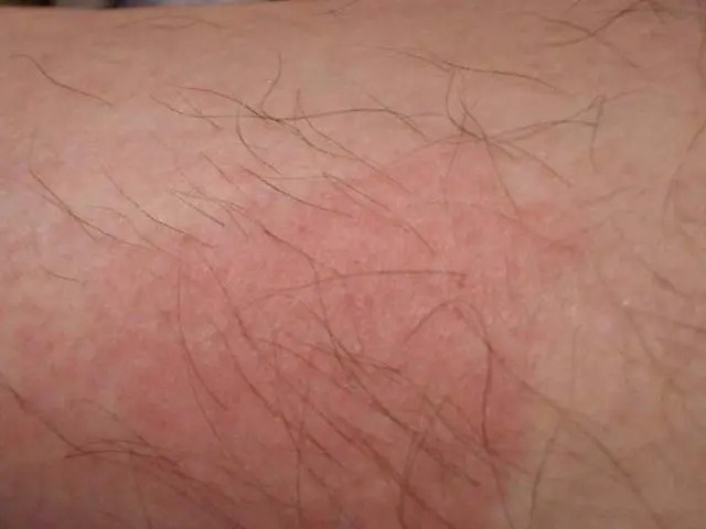 bed bug bite skin rash 48 hours after bite