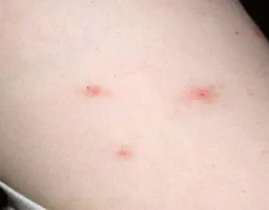 three bed bugs bites on arm