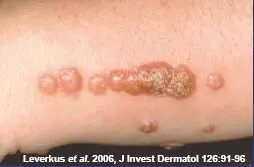 bed bug bite blisters in single row pattern