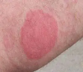 Bed bug bite on arm with wheal reaction