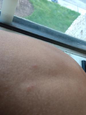 2nd day. Natural light hides the redness, no visible dark spot but with magnifier glass there's a small black spot with Little white pus/selbum?