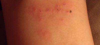 My marks, I also broke the skin it was irresistable to scratch! I hear it could get infected so I put some medicine/ointment on it.