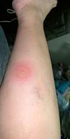 Bed Bug Bite